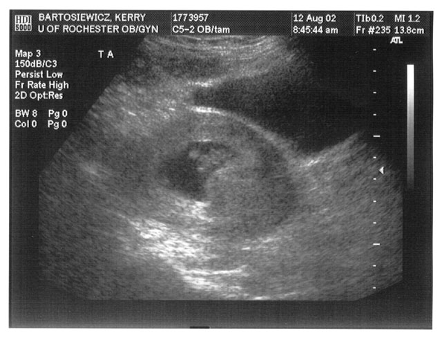 ultrasounds at 8 weeks. Brother/Sister at 8 Weeks
