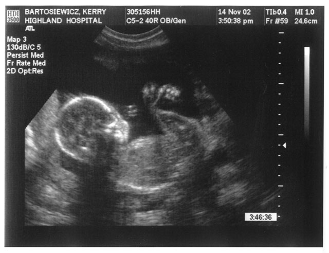 ultrasounds at 8 weeks. Twins Ultrasound At 8 Weeks 5